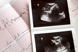 Ohio Passes Heartbeat Bill: New Law Bans Abortion from the Moment a Heartbeat can be Detected
