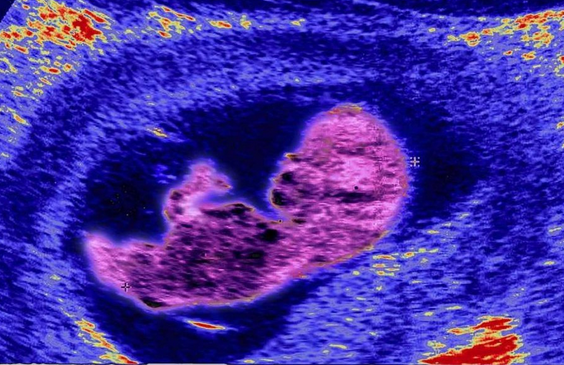 States Continue ‘Unprecedented’ Surge of Pro-life Bills, take a look:
